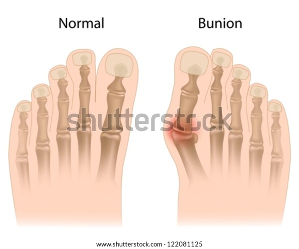 Bunion Foot Stock Vector (Royalty Free) 122081125 | Shutterstock