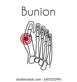 Bunion in foot linear icon. Vector abstract minimal illustration of foot with red spot on hallux suffers from pain. Design template for medicine or therapy for valgus deformity or bunion.