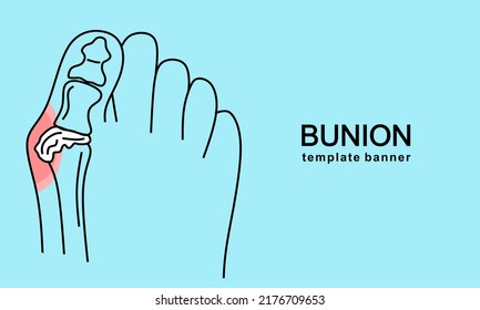 Bunion in foot Template banner. Abstract minimal illustration of foot with red spot on hallux suffers from pain. Design template for medicine or therapy for valgus deformity or bunion.