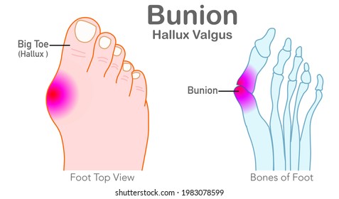 Bunion, Hallux Valgus. Foot Bones, Joint Deformed Feet. Top View Of The Foot, Angle Of The Big Toe. Orthopedic Treatment, Scalloped Shoes. Illustration Medical Draw Vector