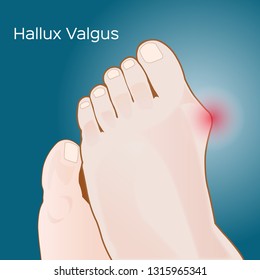 Bunion- hallux valgus Vektorgrafik auf blauem Hintergrund