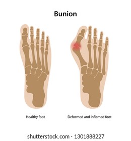 Bunion.  Healthy foot and deformed and inflamed foot. From above view. Vector illustration