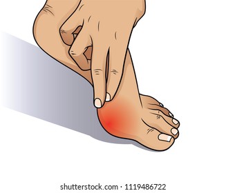 Bunion at sides of foot.