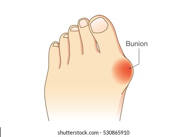 Bunion at sides of foot. Bone and skin on the sides of joint of the big toe make abnormal foot shape. Common problem form wearing high heel.