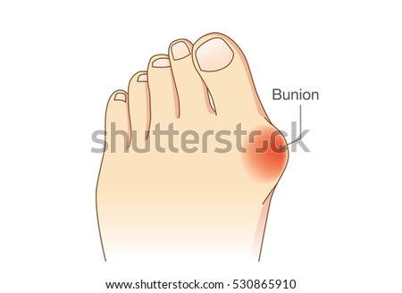 Bunion at sides of foot. Bone and skin on the sides of joint of the big toe make abnormal foot shape. Common problem form wearing high heel.