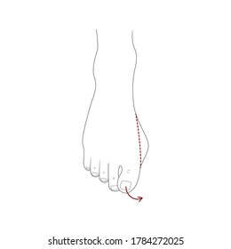 Corrección quirúrgica de unión. Ilustración vectorial. Ortopedia médica