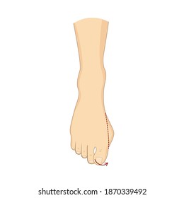 Bunion Surgery Correction. Vector Illustration. Orthopedics Health