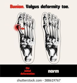 Bunion. Valgus deformity toe.