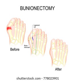 Bunionectomy is a procedure to correct of pathologies and deformity of the joint connecting the big toe to the foot. Before and after of Surgery. Healthy foot and foot with Bunion. Human Skeleton