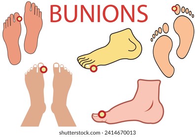 Bunion,Realistic bunion foot composition,damaged human footsteps vector illustration,foot with hallux valgus, bunion, deformitie of big toe joint - vector illustration,deformitie of big toe joint