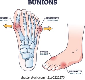 Bunions And Bunionette As Feet Bone Disorder Condition Outline Diagram. Labeled Educational Medical State With Hallux Valgus Deformation Disease Vector Illustration. Big Toe And Foot Connected Joint.