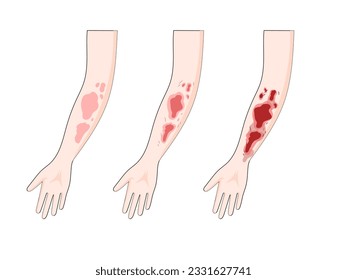 Schaltplan für den Brenngrad, Vektorgrafik. Illustration in der Medizin