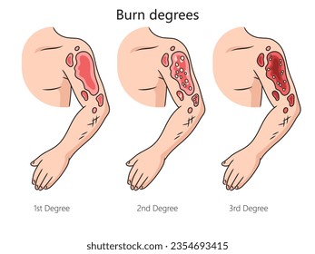 Burn degree diagram schematic vector illustration. Medical science educational illustration