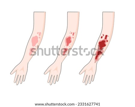 burn degree diagram schematic vector illustration. Medical science educational illustration
