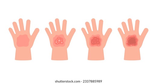 Quema de la piel del niño de la mano de diferente grado. Primeros auxilios para incendios o lesiones químicas en la piel. Quema de síntomas visuales. Ilustración del vector