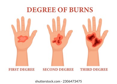 Burn stages. Burnt hands at various degrees. Skin burn symptoms. Medical healthcare concept. Vector	
