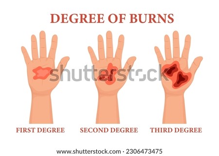 Burn stages. Burnt hands at various degrees. Skin burn symptoms. Medical healthcare concept. Vector	
