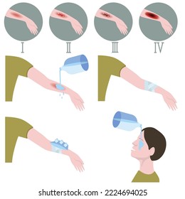 Burn stages. First aid for thermal injuries of the body and fires. Medical infographic. Vector illustration