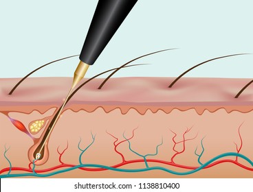 Burning hair root with needle epilation