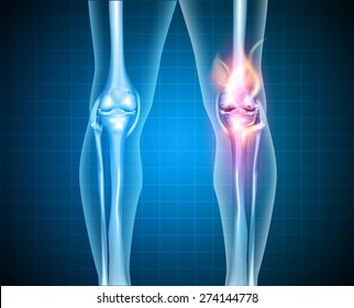 Burning knee, painful knee and normal knee joint, abstract design. Human legs on a blue checkered background.