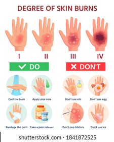 Grado de quemaduras. Primeros auxilios para heridas quemadas. Daños de incendio a la clasificación de la piel. Blisters de mano. Tratamiento de infografía vectorial para la herida térmica. Ilustración lesión dolor daño, ayuda médica