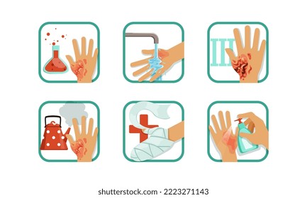 Burns Degree and First Aid or Treatment with Wounded Hand Vector Set