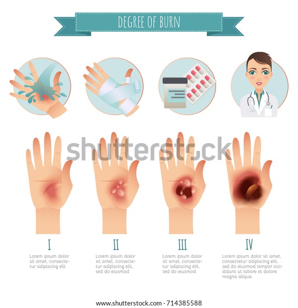 Burns Treatment Degree Skin Burns Vector Stock Vector (Royalty Free ...