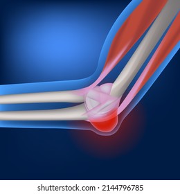 bursitis of the elbow joint. Anatomy of the bones of the hands. Limb on a blue background. Vector illustration