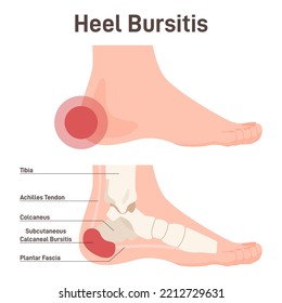 Bursitis. Heel joint inflammation. Inflamed or irritated bursae of synovial fluid. Musculoskeletal system disease. Flat vector illustration