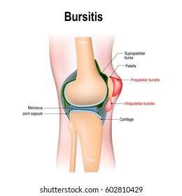 Bursitis. inflammation of bursae (synovial fluid). Prepatellar bursitis (housemaid's knee) and Infrapatellar bursitis