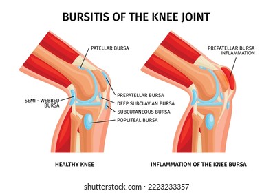 Bursitis of knee bursa realistic infographics with anatomy of healthy and unhealthy joints vector illustration