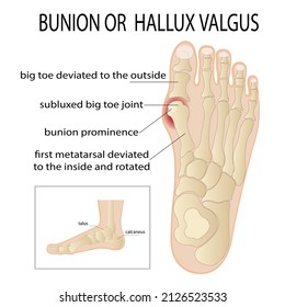 Bursitis on the sides of the foot. The bone and skin on the sides of the big toe joint form an abnormal foot shape. Common problem