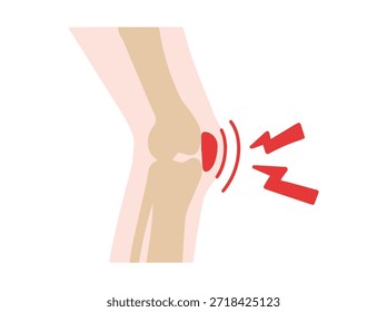 Bursitis Enfermedad prepatelar en la rodilla