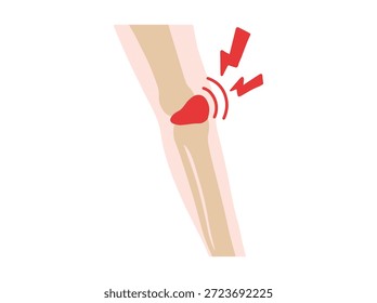 Bursitis Prepatellar Disease in Knee