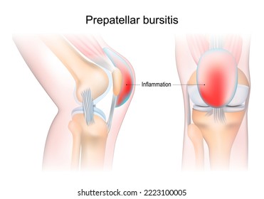 bursitis. Prepatellar bursitis. inflammation of sacs with synovial fluid. Front and side view of human knee joint. Lateral and anterior section of the knee. vector illustration.