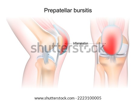 bursitis. Prepatellar bursitis. inflammation of sacs with synovial fluid. Front and side view of human knee joint. Lateral and anterior section of the knee. vector illustration.