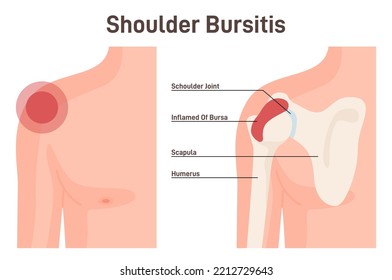 Bursitis. Shoulder joint inflammation. Inflamed or irritated bursae of synovial fluid. Musculoskeletal system disease. Flat vector illustration