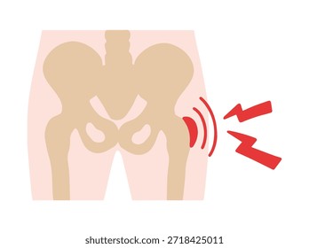 Bursitis Enfermedad Trocanterica en la Cadera