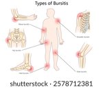 bursitis types, including elbow, shoulder, hip, knee, and heel, with inflamed bursae locations diagram hand drawn schematic vector illustration. Medical science educational illustration