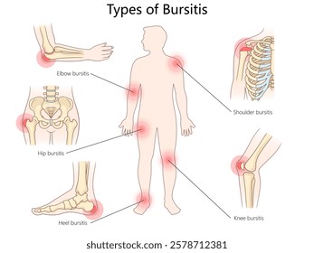 bursitis types, including elbow, shoulder, hip, knee, and heel, with inflamed bursae locations diagram hand drawn schematic vector illustration. Medical science educational illustration