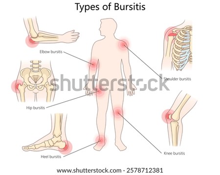 bursitis types, including elbow, shoulder, hip, knee, and heel, with inflamed bursae locations diagram hand drawn schematic vector illustration. Medical science educational illustration