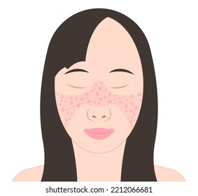 butterfly and malar rash chronic facial Pain joint inflammatory hair loss kidney failure Raynaud’s disease face purple pale