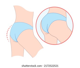 buttock enhancement augment surgery graft Brazilian Butt lift