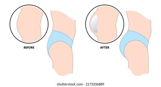 buttock enhancement augment surgery graft Brazilian Butt lift