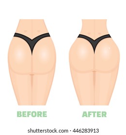 Buttocks, breech, butt, rear, nates augmentation consept. Before an After. Increase buttocks