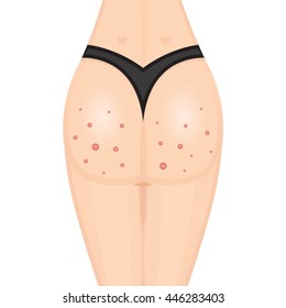Buttocks, breech, butt, rear, pimple, acne