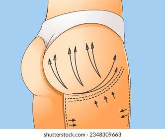 Buttocks Enhancement. Non-surgical correction. Save area. Sciatic nerve. Healthcare illustration. Beauty illustration. Vector illustration. 