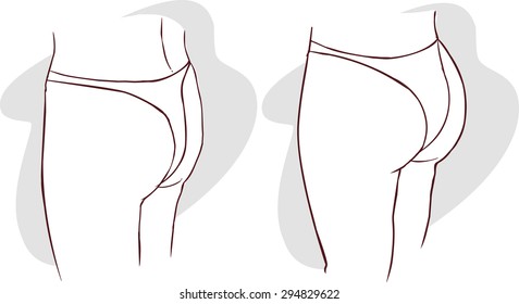 buttocks  implants