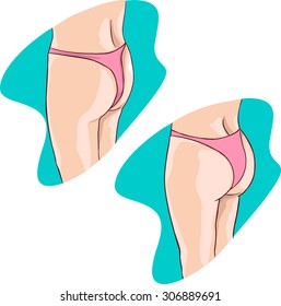 buttocks implants