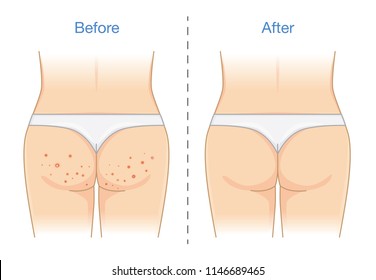 Buttocks with many pimples and after skin treatment. Illustration about health care.
